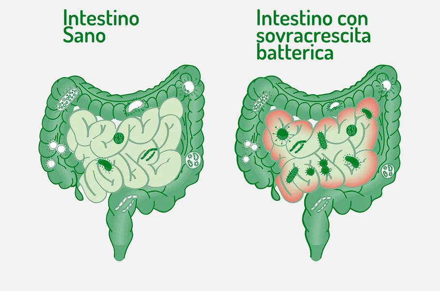 SIBO, sovraccrescita batterica intestinale